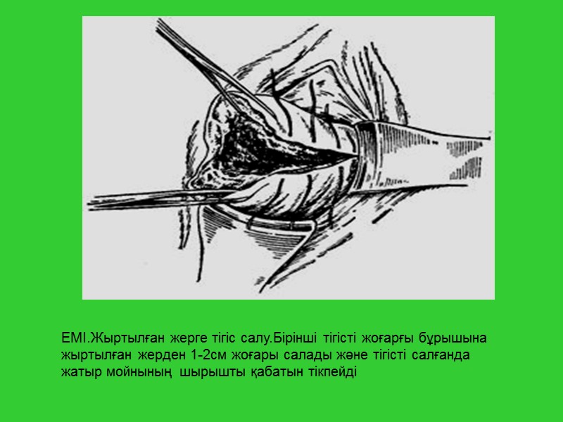 ЕМІ.Жыртылған жерге тігіс салу.Бірінші тігісті жоғарғы бұрышына жыртылған жерден 1-2см жоғары салады және тігісті